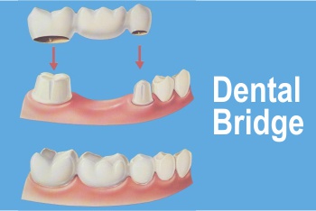 Dental Bridge